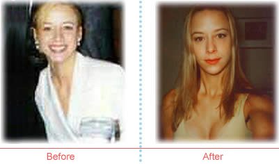 Stacy Schweiss breast enlargement before and after photos