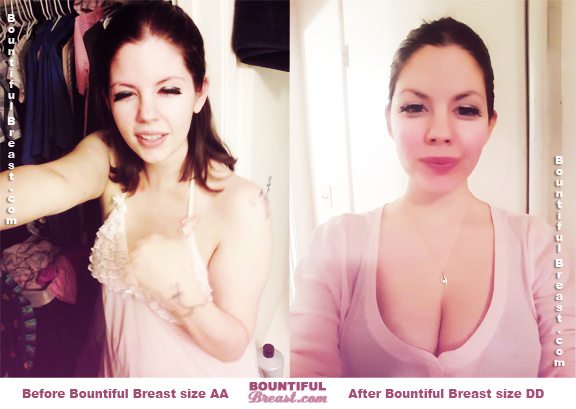 Teresa T. breast enlargement before after pics